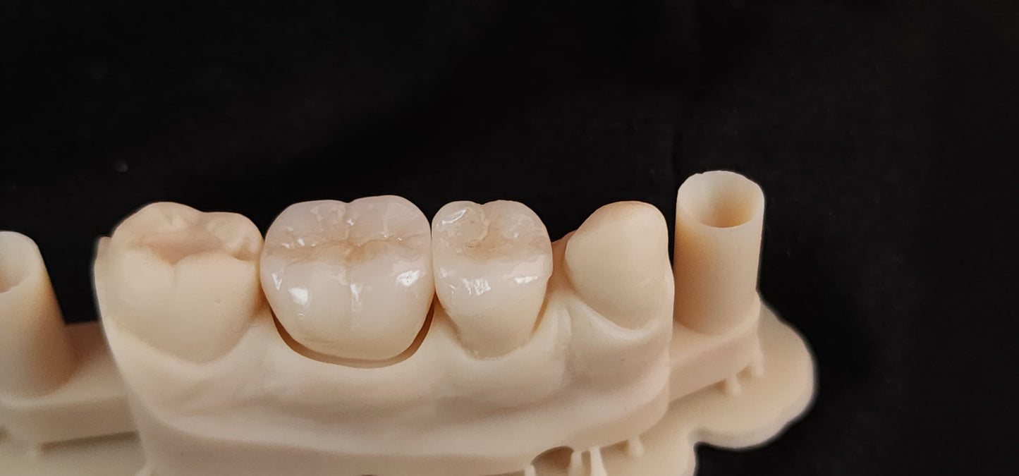 Monolithic Zirconia Crown