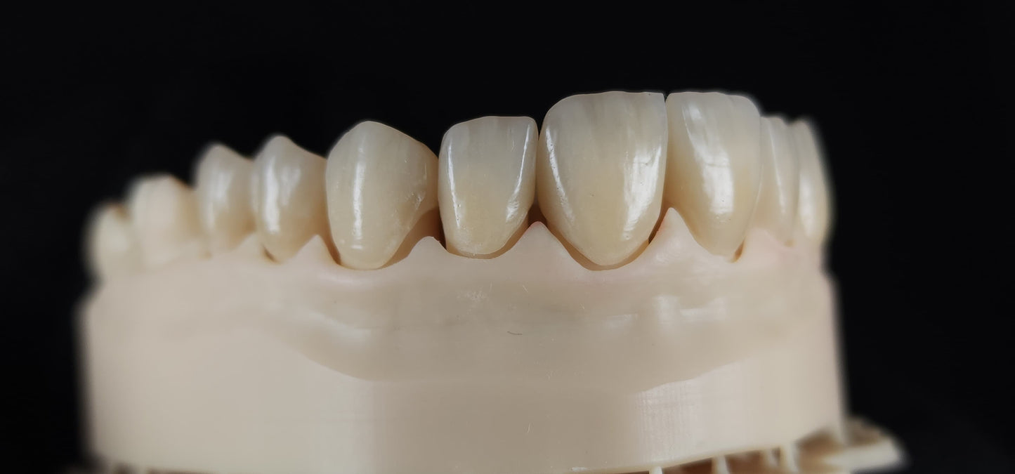 Emax Veneers - Layering Technique