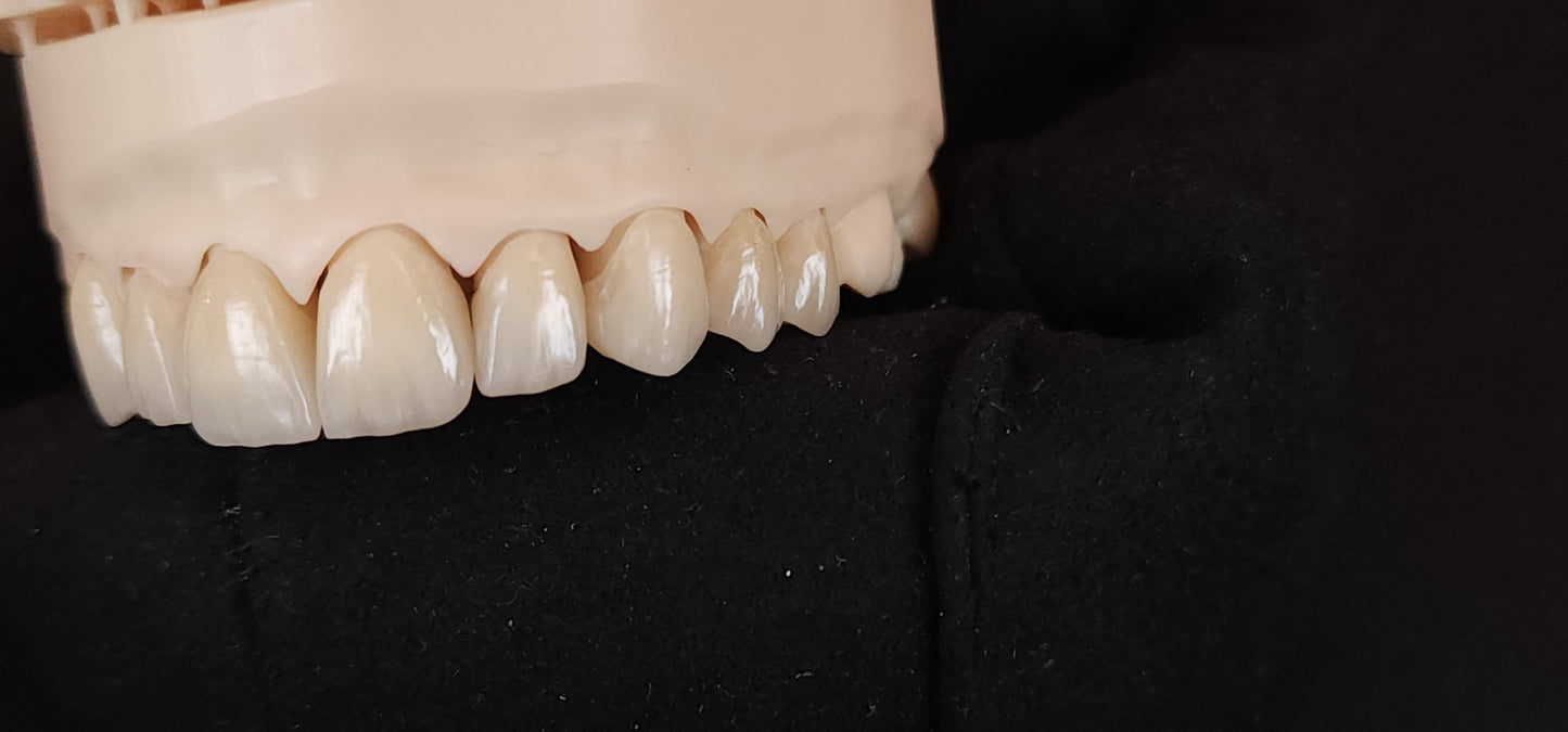 Emax Veneers - Layering Technique