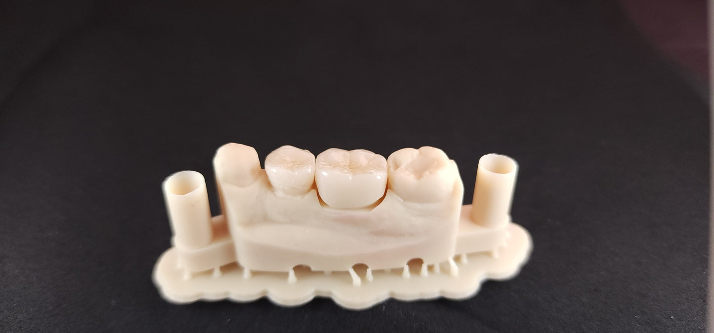 Monolithic Zirconia Crown