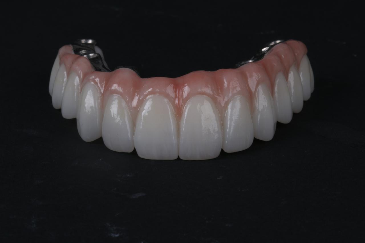 Customized Dental Restoration