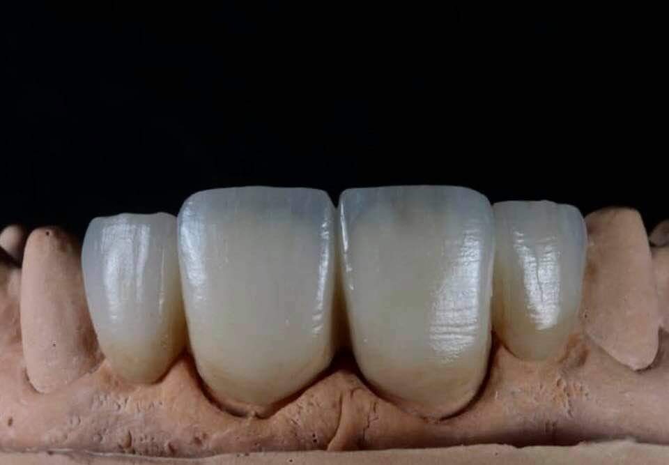 Customized Dental Restoration