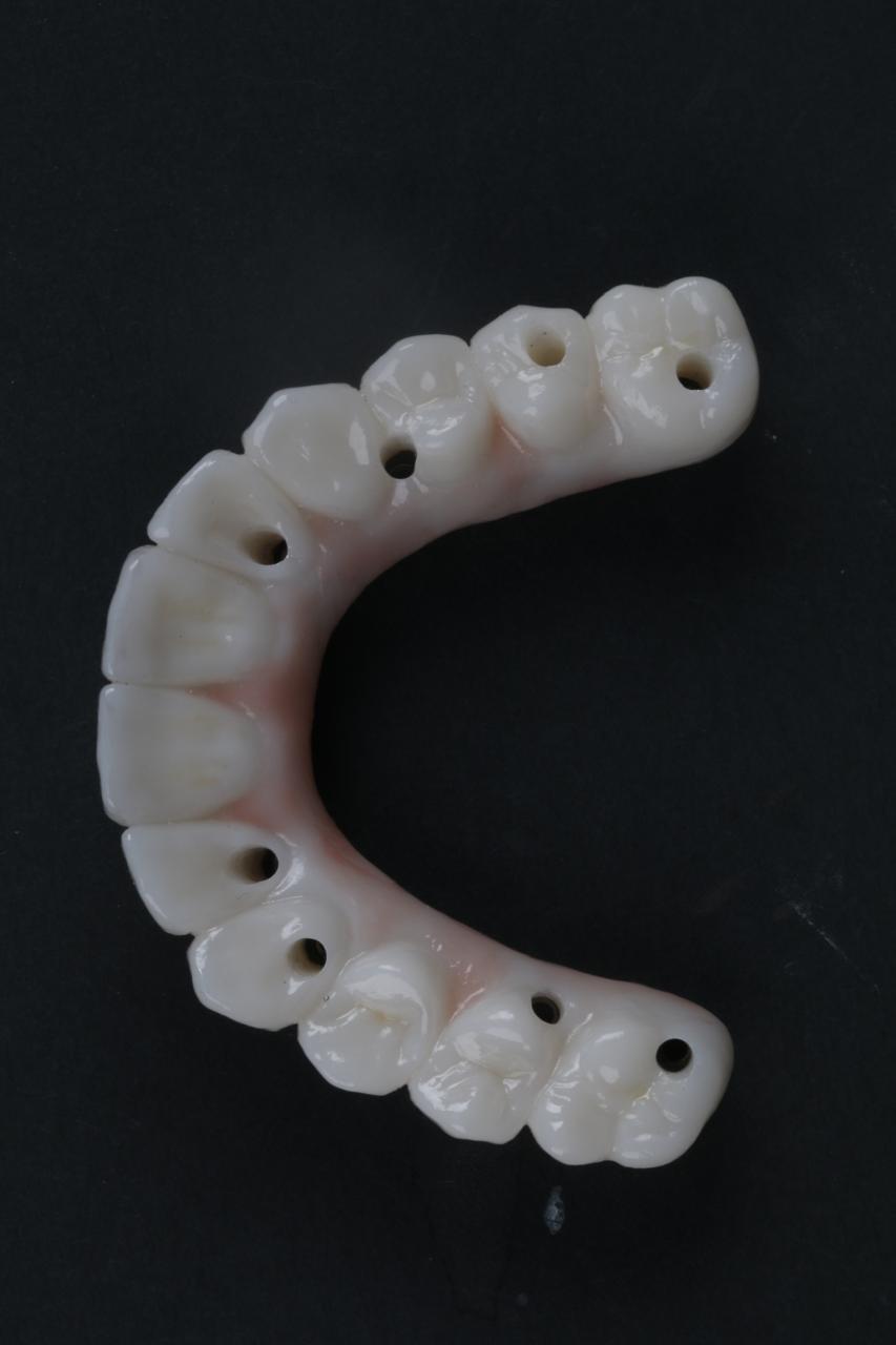 Titanium Bar with Zirconia (12 Teeth)