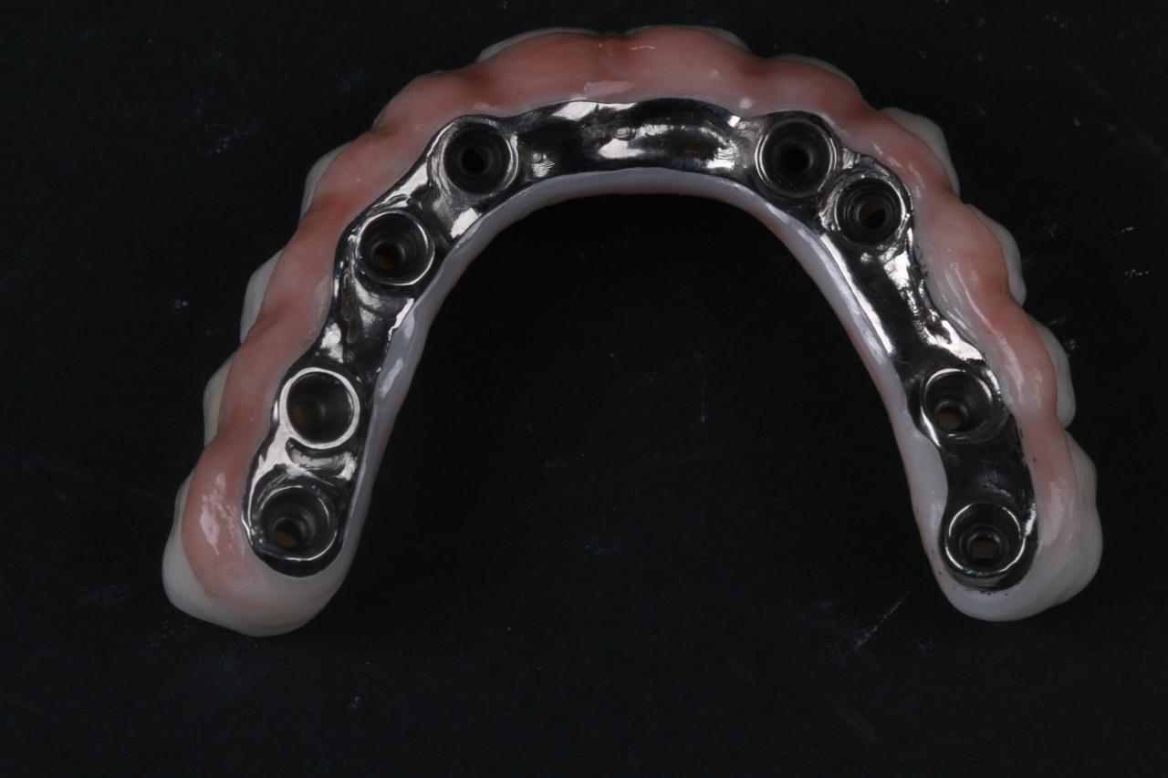 Titanium Bar with Zirconia (12 Teeth)