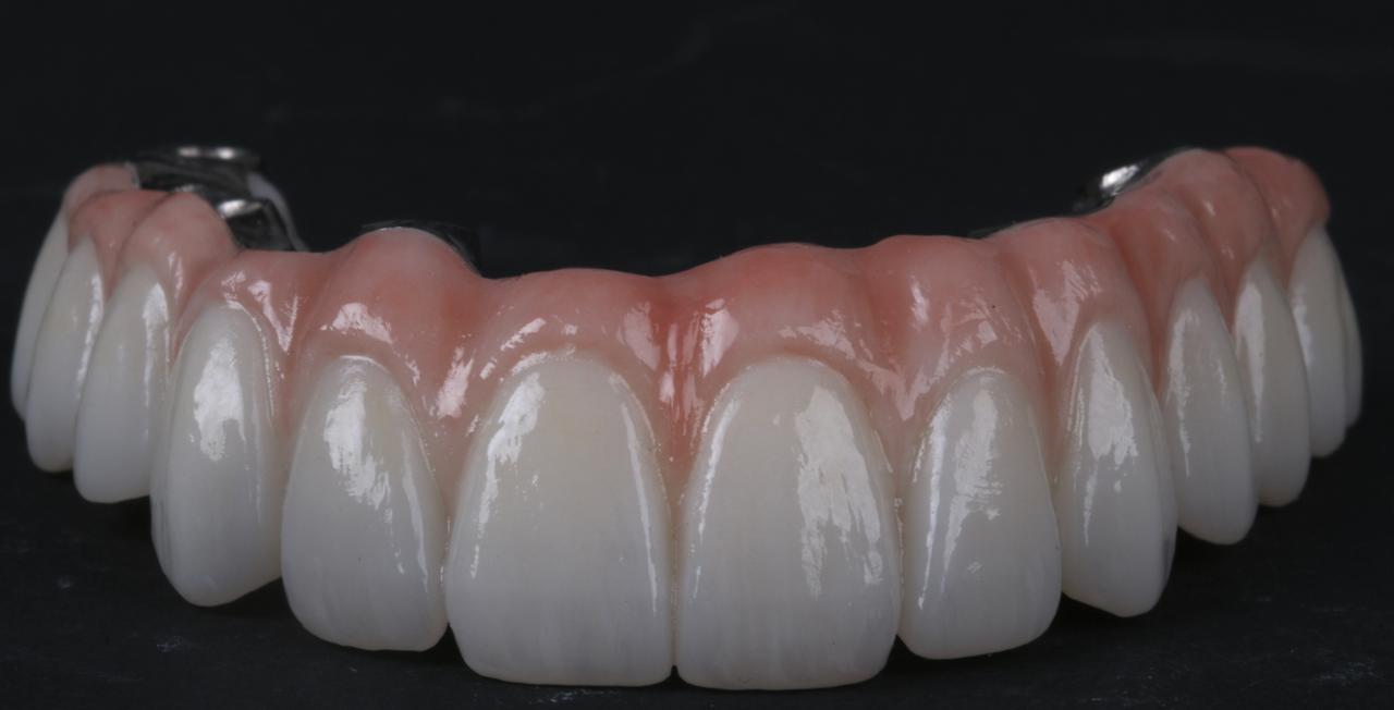 Titanium Bar with Zirconia (12 Teeth)