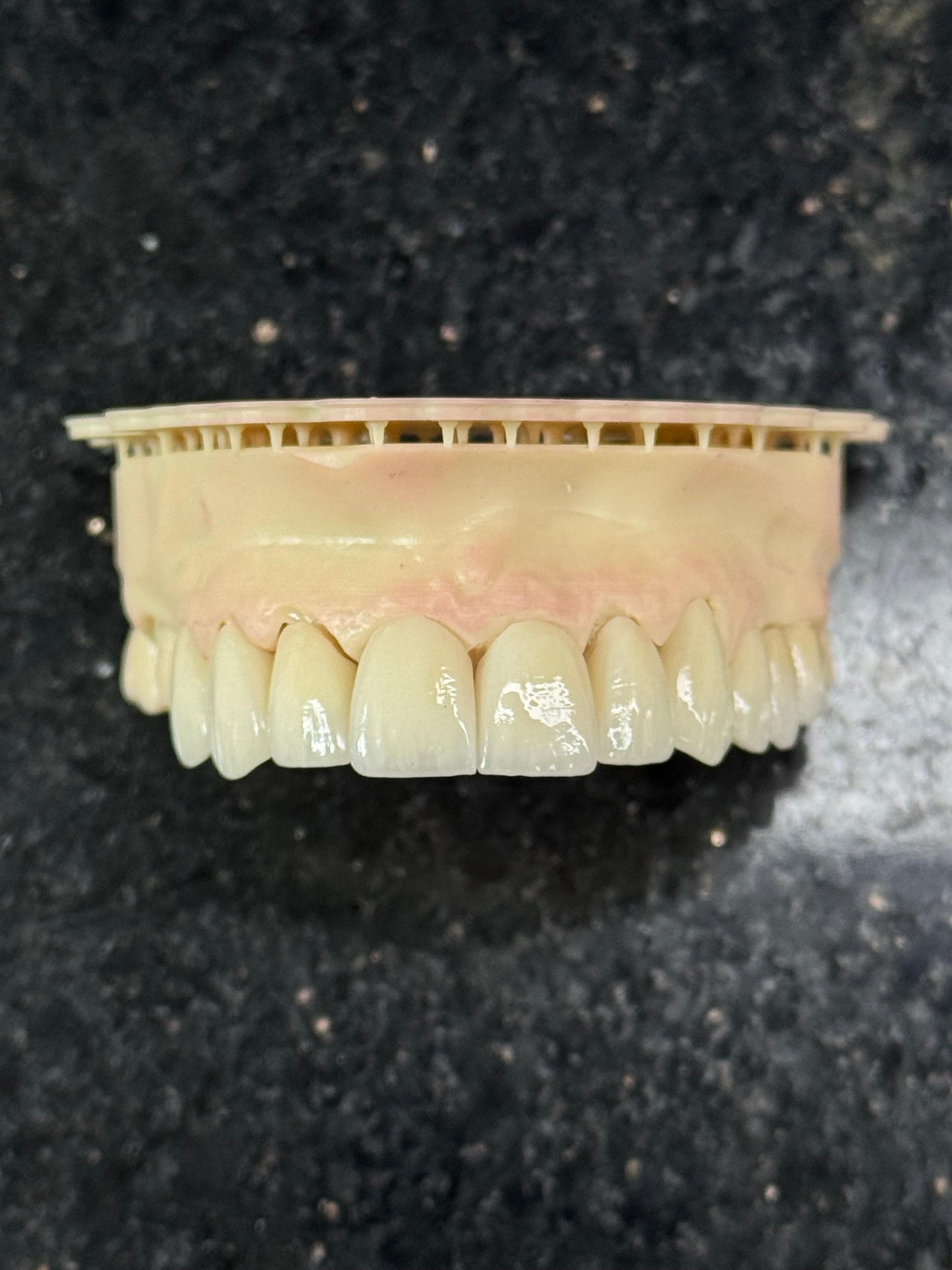 Customized Dental Restoration