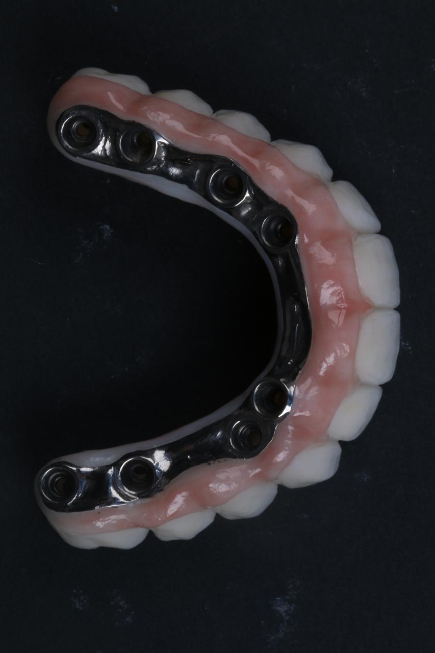 Titanium Bar with Zirconia (12 Teeth)