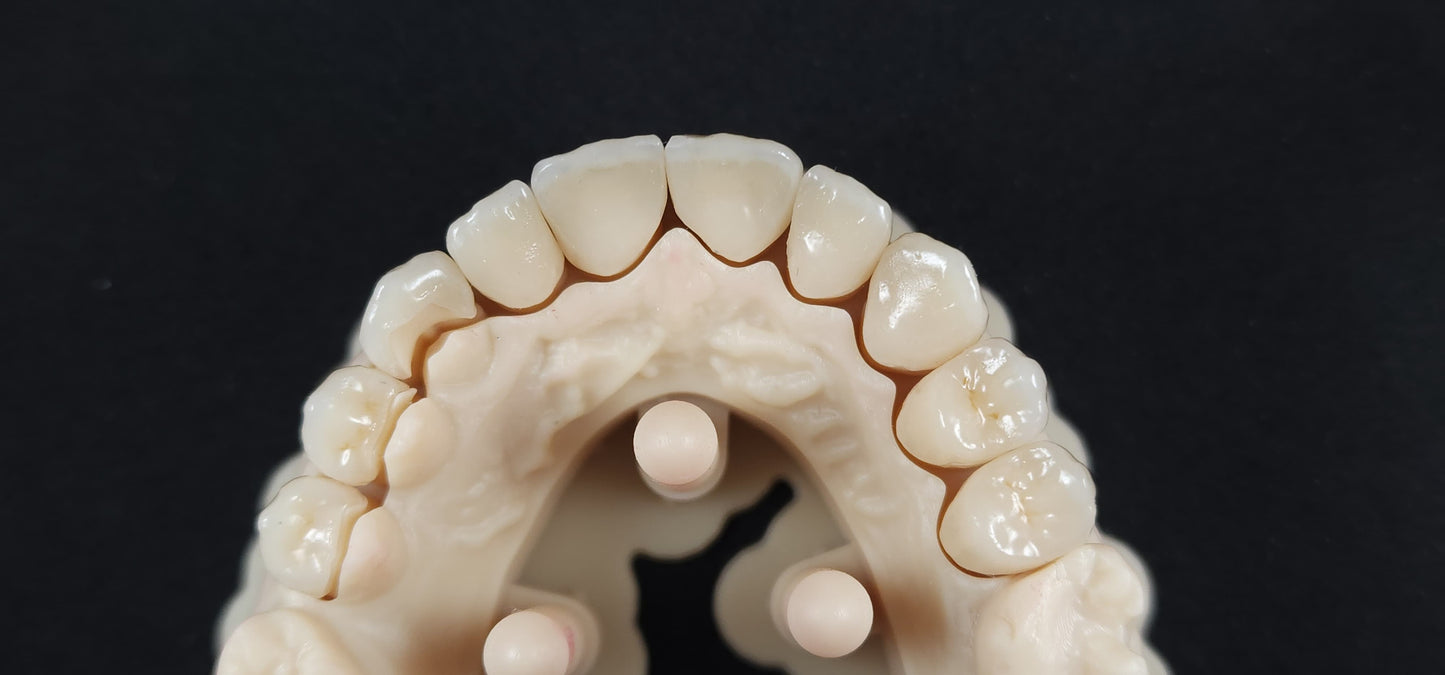 Emax Veneers - Layering Technique
