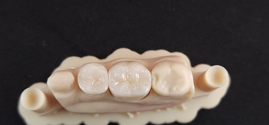 Monolithic Zirconia Crown